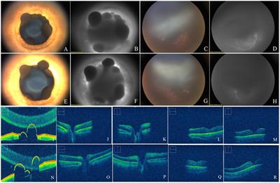 Multimodal optical imaging of iris flocculi in three consecutive generations: a case report
